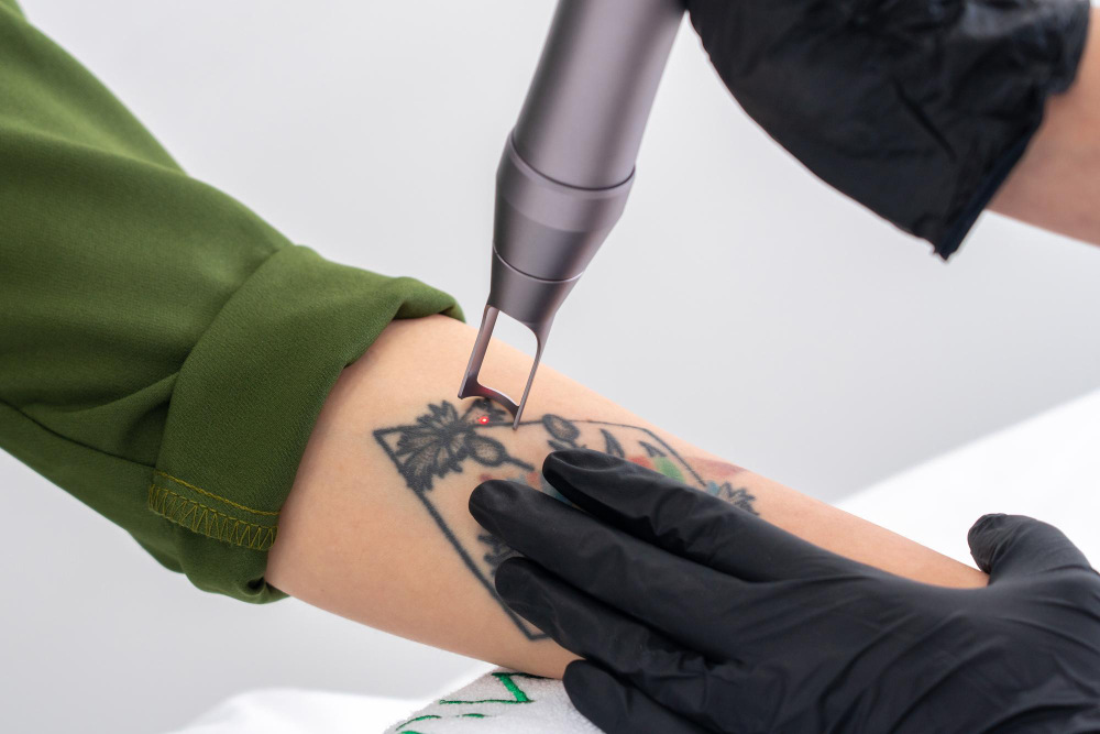 Laser Tattoo Removal in Portland