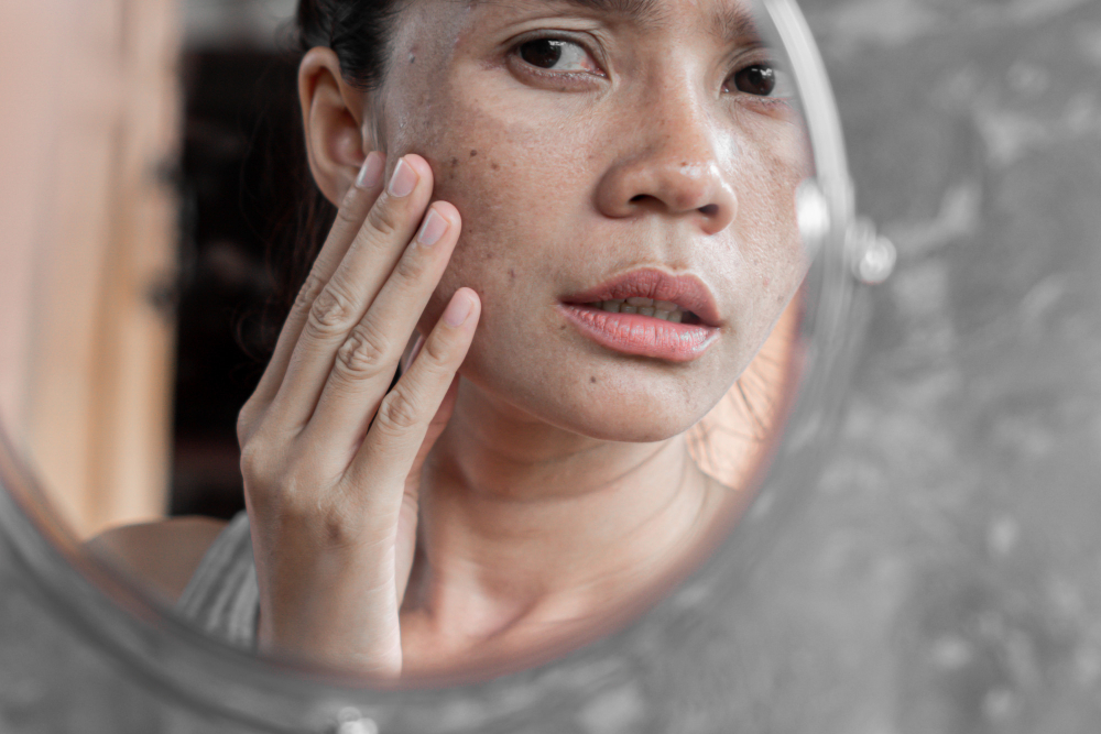 Melasma and Hyperpigmentation Treatments in Portland