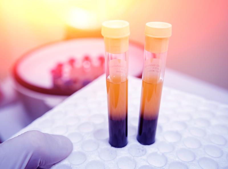 Platelet-Rich Plasma / Platelet-Rich Fibrin in Portland